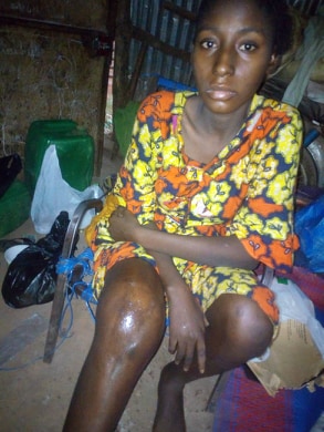 SOS : Si rien n’est fait, Kadidiatou SAMAKÉ, du Djoliba AC risque de perdre l’usage de son pied droit